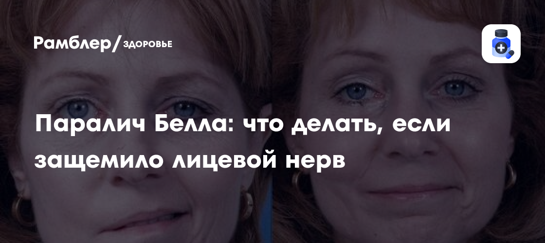 Паралич Белла: что делать, если защемило лицевой нерв - Рамблер/здоровье