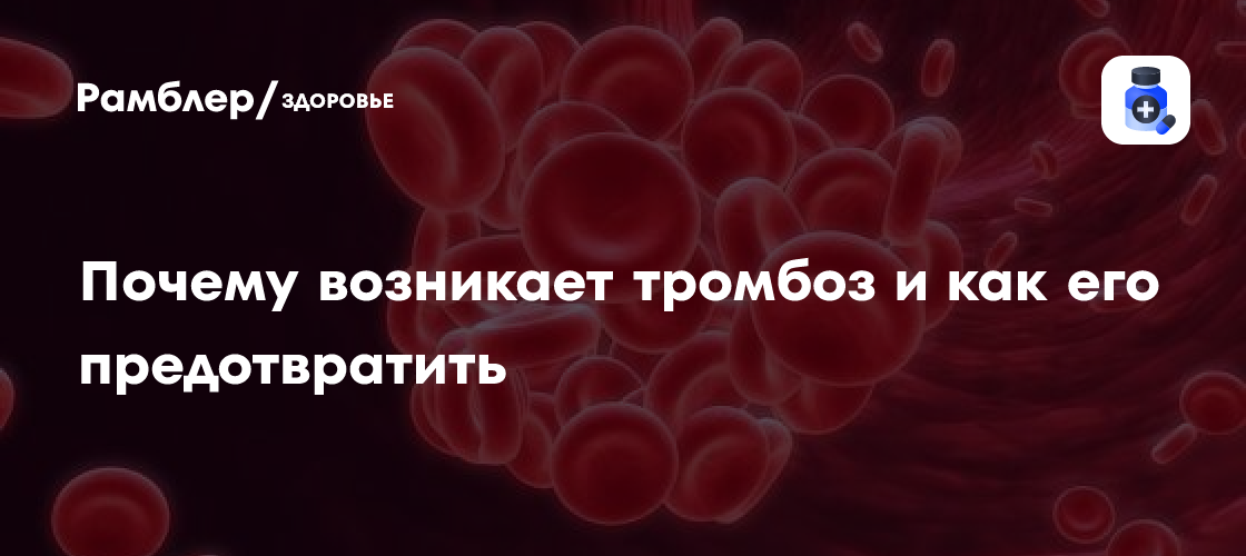 Тромбоз: причины возникновения и методы профилактики