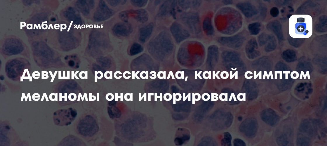 Упущенные годы: 26-летняя британка рассказала о симптоме рака кожи, который игнорировала долгие годы