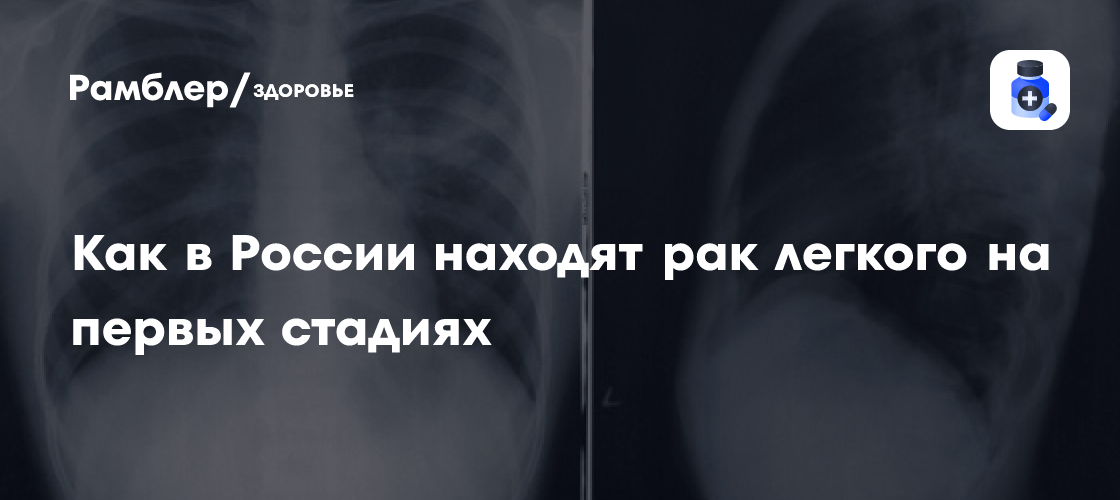 Прорыв в диагностике рака легкого: Новый метод выявляет болезнь на ранних стадиях в 2-3 раза эффективнее